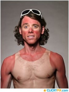 Portrait of male with bad sunburn